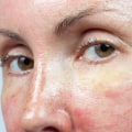 Understanding Redness and Irritation After a Chemical Peel