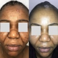 Understanding Multiple Sessions and Layering for Chemical Peels