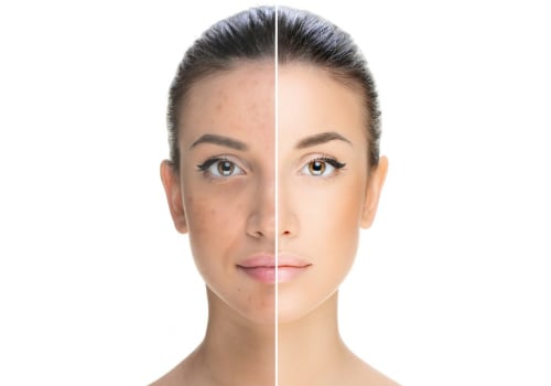 Avoiding Sun Exposure and Harsh Products: Protecting Your Skin Before and After a Chemical Peel