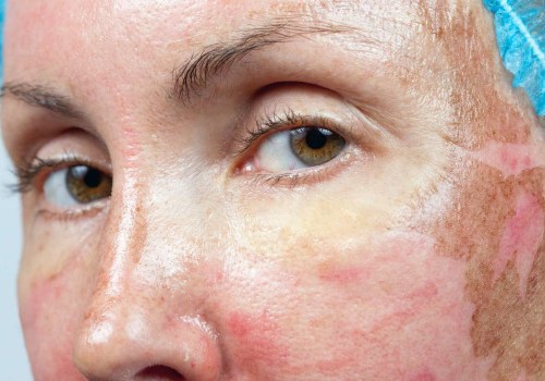 Understanding Redness and Irritation After a Chemical Peel