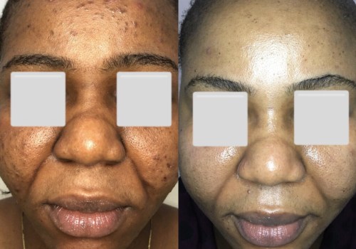 Understanding Multiple Sessions and Layering for Chemical Peels